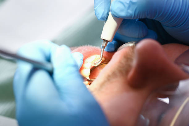 Best Emergency Dental Care for Broken or Chipped Teeth in Allentown, PA